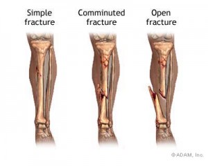 bone setting