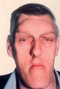 acromegaly