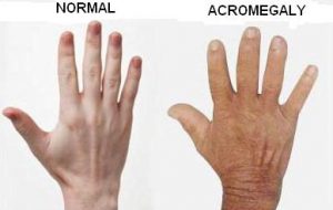 acromegaly